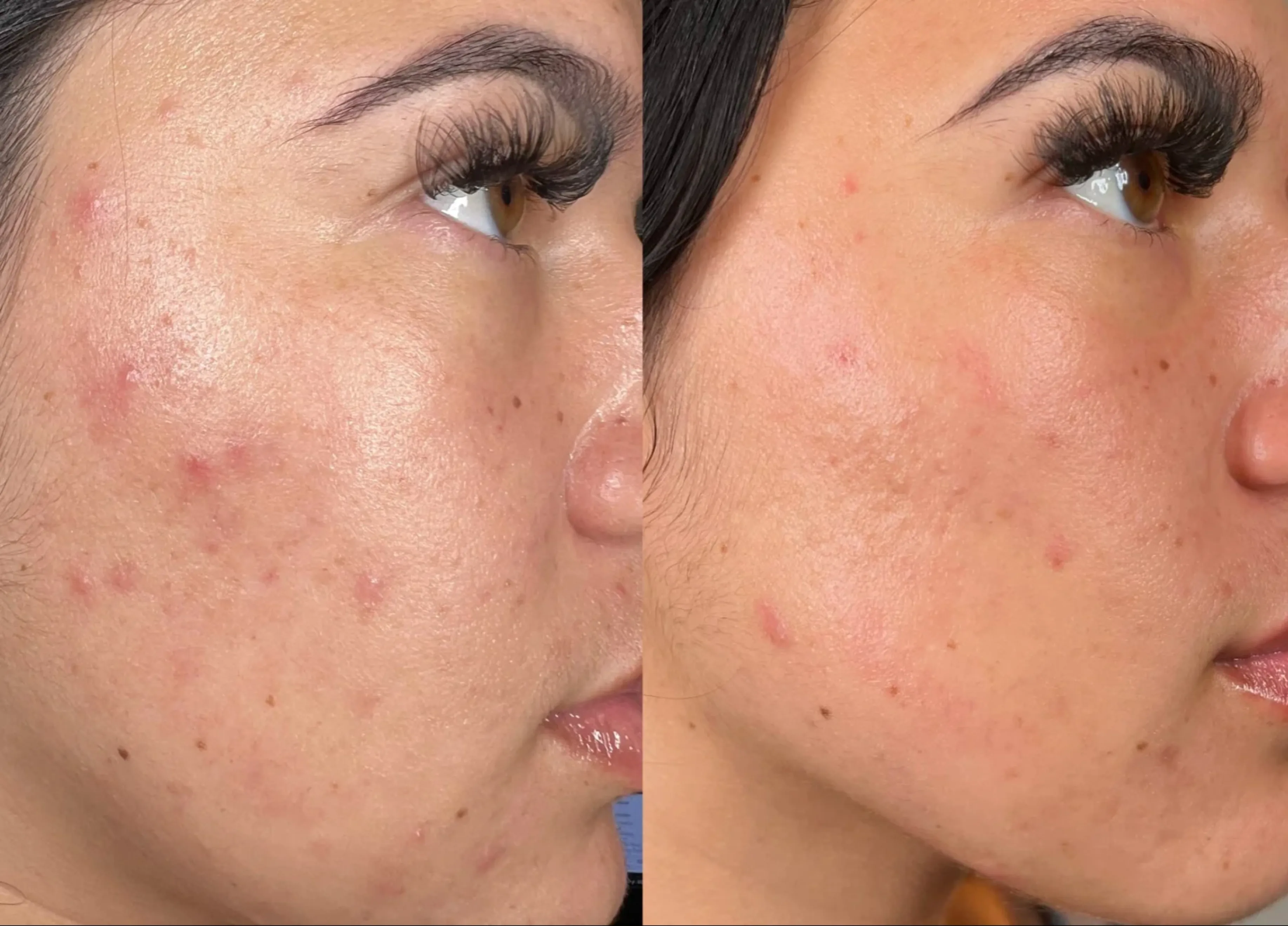 Hydraneedling in Seattle: HydraFacial + Nanoneedling for Radiant Skin